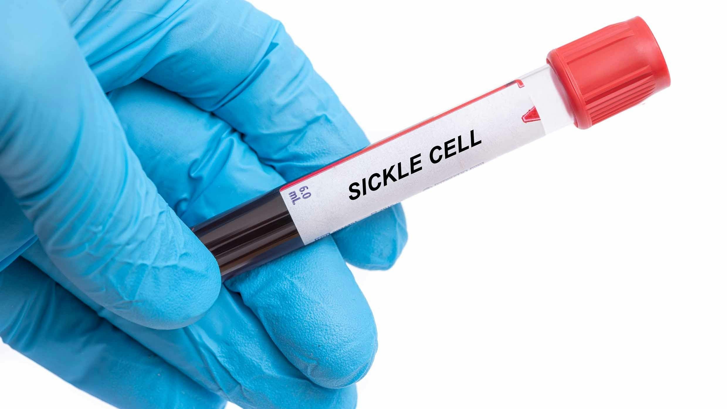 Sickle Cell. Sickle Cell disease blood test in doctor hand